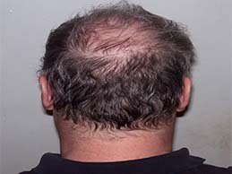 Wart Removal Clinic in Indirapuram