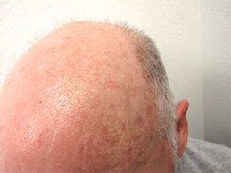 Tattoo Removal in Indirapuram